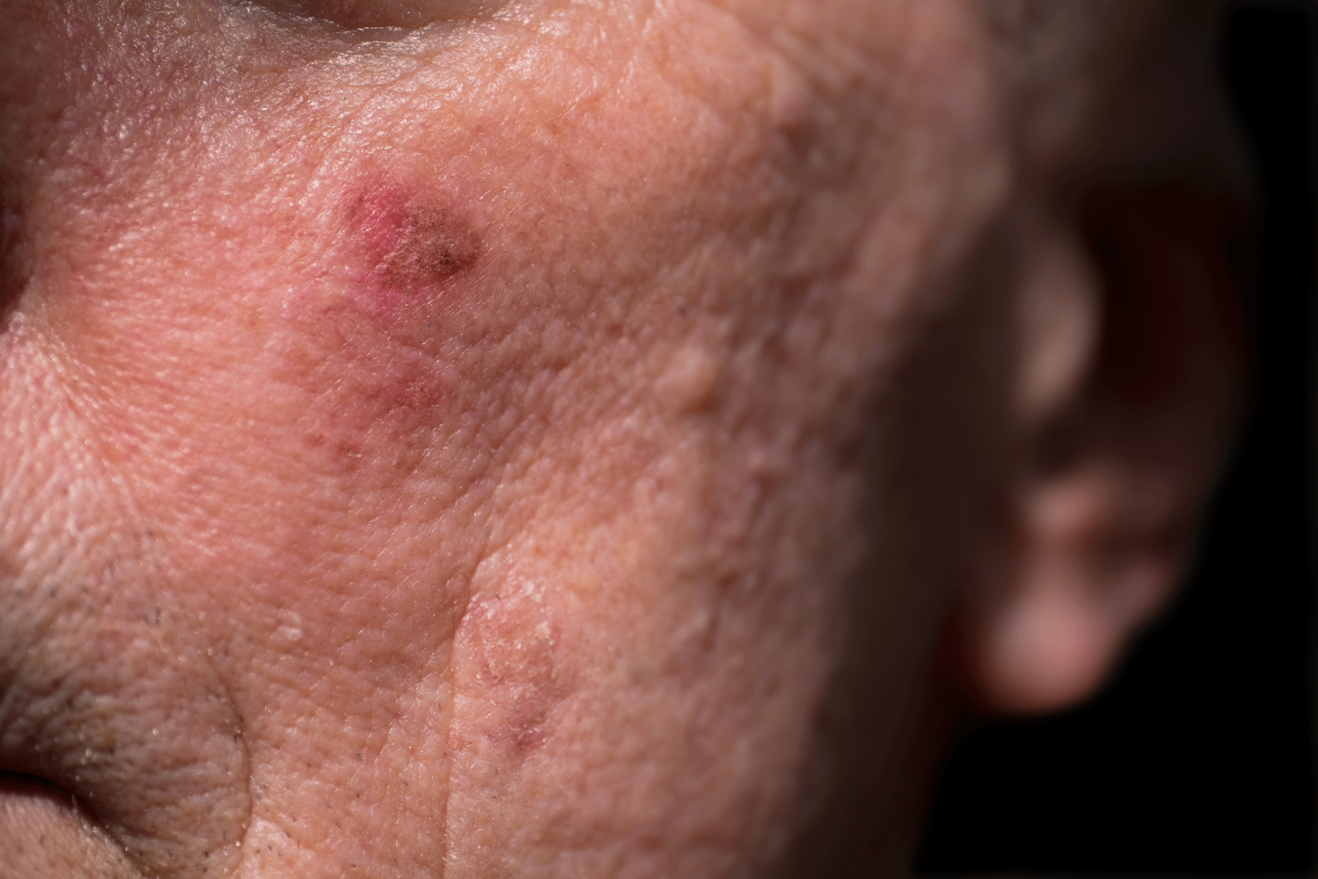 Actinic Keratosis