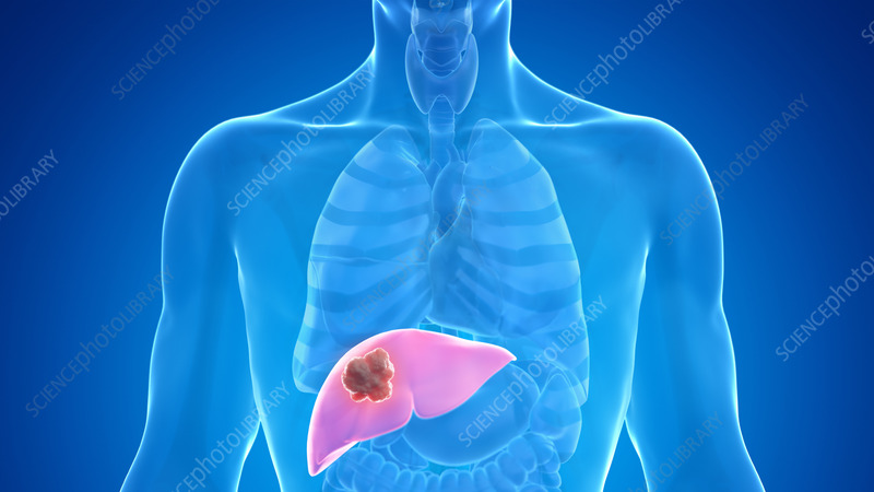 Liver Cancer