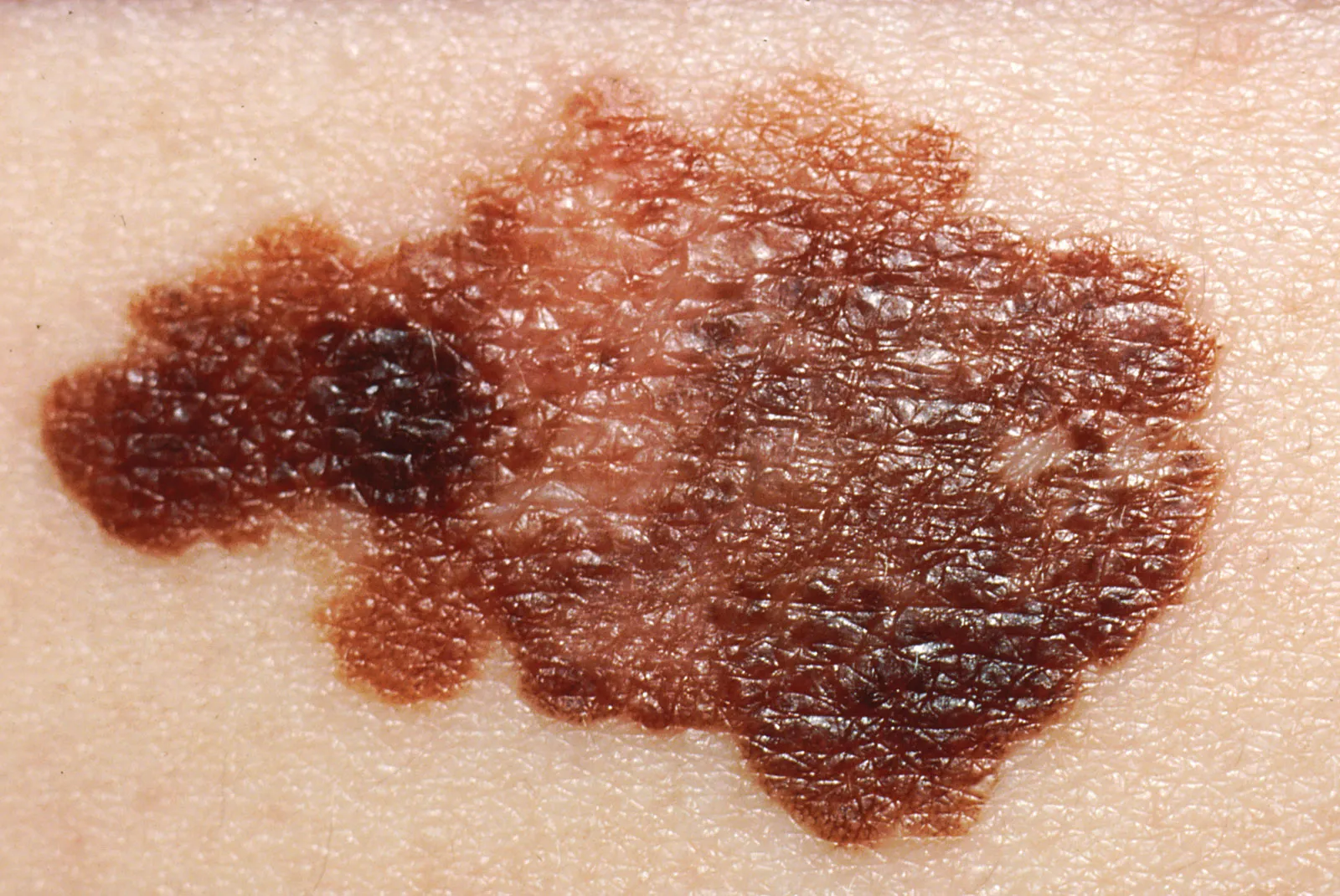 Malignant Melanoma