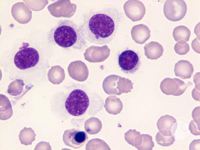 Hairy Cell Leukemia